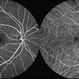 Macular Telangiectasia Type 2 Macular Telangiectasia Type 2